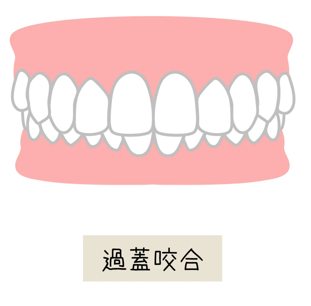 過蓋咬合を改善しよう！
